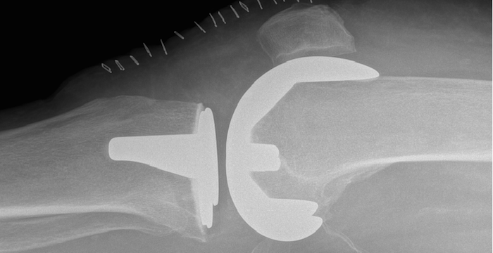side xray of knee implant